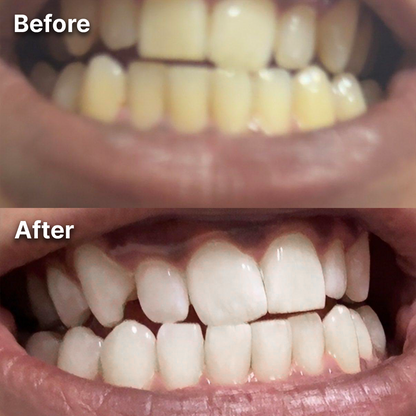 Purple Whitening Strips