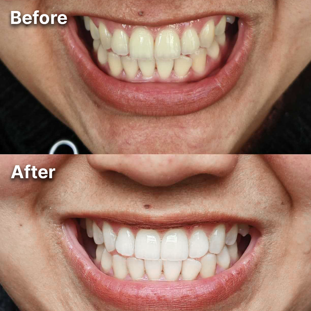 Purple Whitening Strips