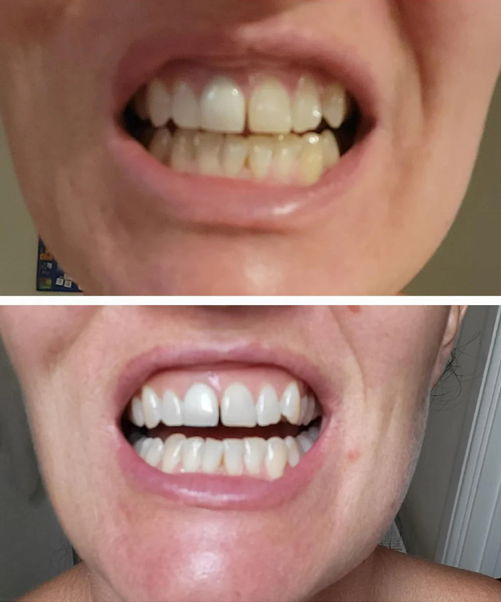 Purple Whitening Strips